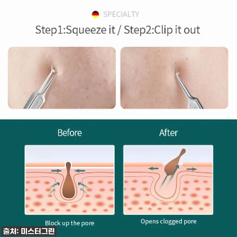 미스터그린 여드름 압출기 핀셋 MR-2177 코피지압출기 압출바늘 독일의료용 스테인레스 13 미스터그린 여드름 압출기 핀셋 MR- 관련 이미지 5